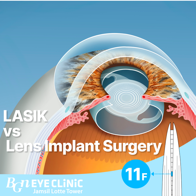LASIK vs ICL Lens Implant Surgery